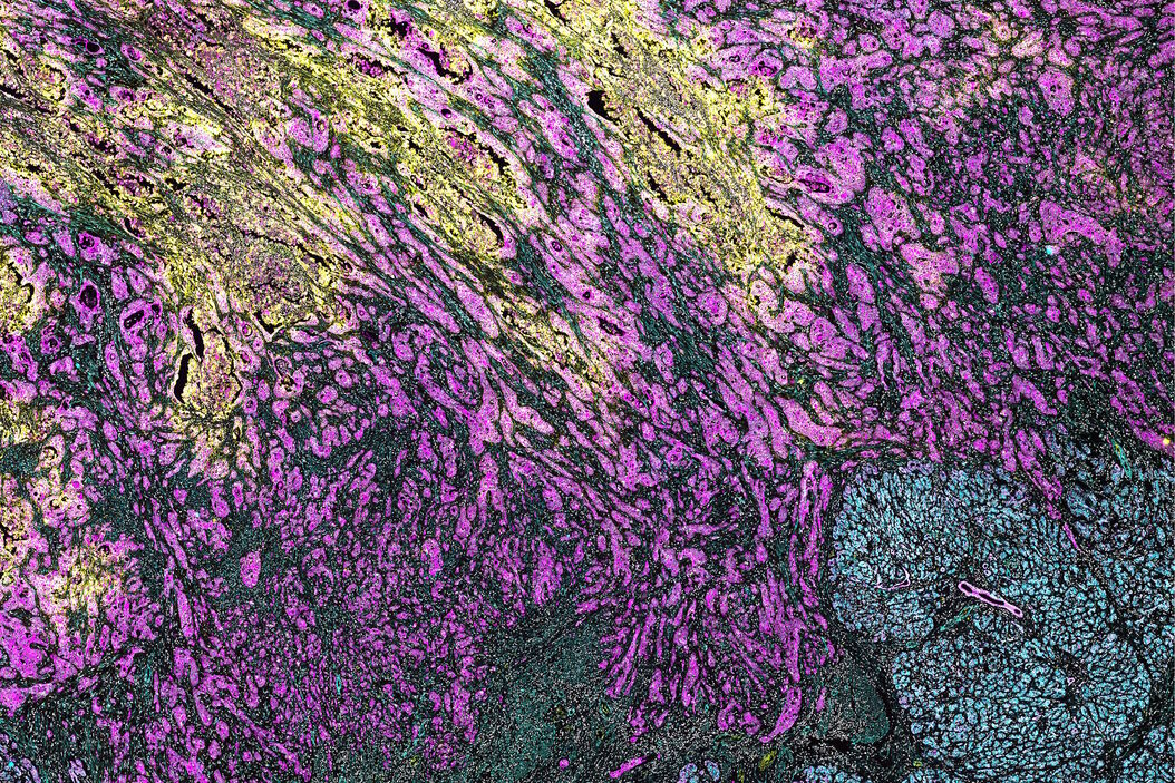 PDAC Multiplexed imaging of CST panels enables an examination of immune cell components in pancreatic ductal adenocarcinoma (IPDAC) tissue on a single slide. Pancreatic_ductal_adenocarcinoma_tissue.jpg