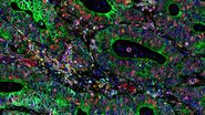 Cell DIVE multiplexed image of FFPE tissue section from human colon adenocarcinoma tissue.