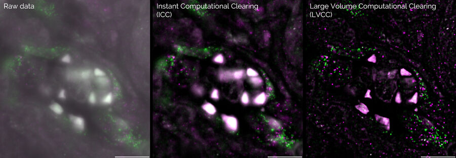 Single molecule RNA-FISH in cancerous tissue labelled with RNA-01 (green) and RNA-02 (magenta). Left) Raw data, Middle) With ICC (instant computational clearing), and Right) After LVCC (large volume computational clearing). Courtesy of A. Moor, University of Zurich, Switzerland.