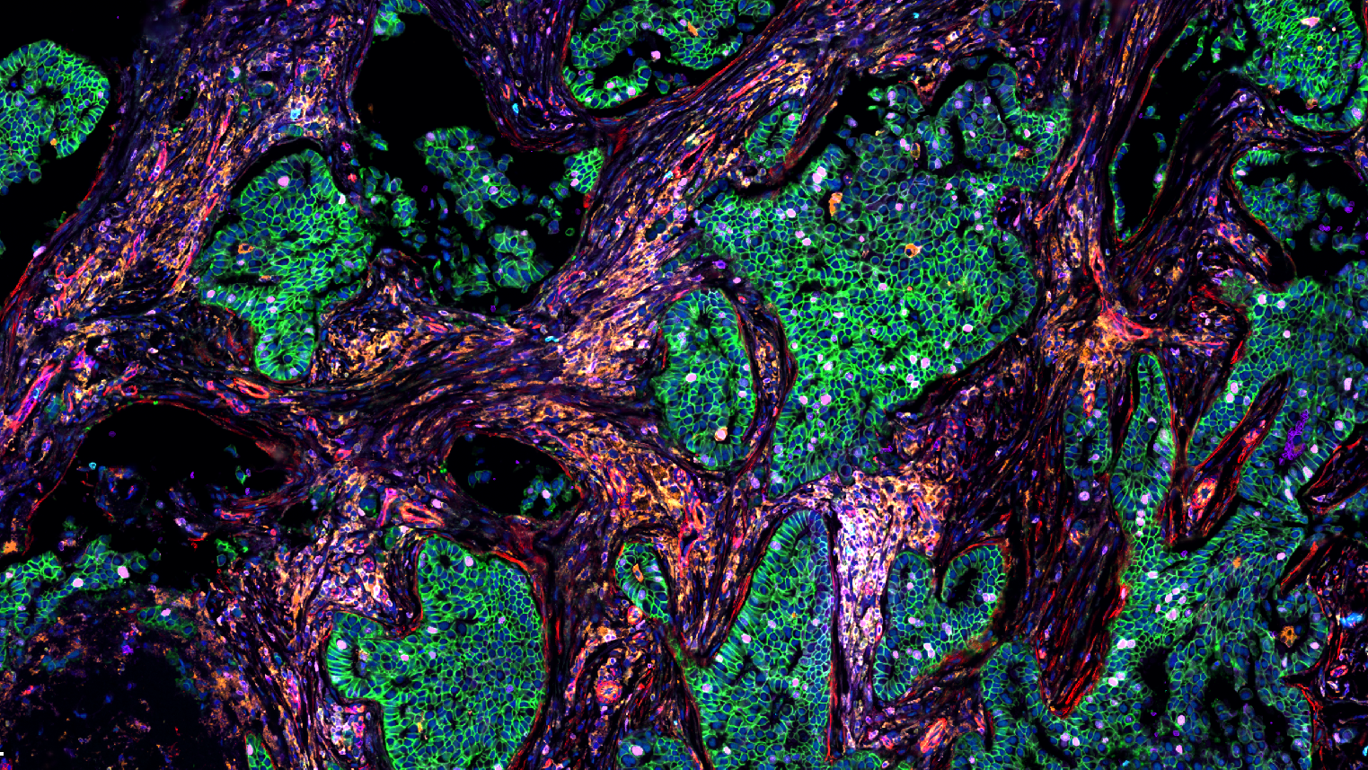 人体浸润性导管癌（IDC）FFPE 组织切片的Cell DIVE 多重成像。