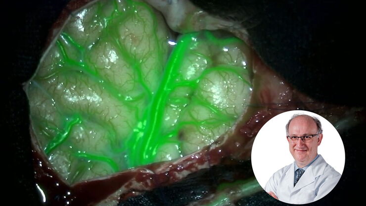 GLOW800 Augmented Reality fluorescence in Moyamoya disease treatment