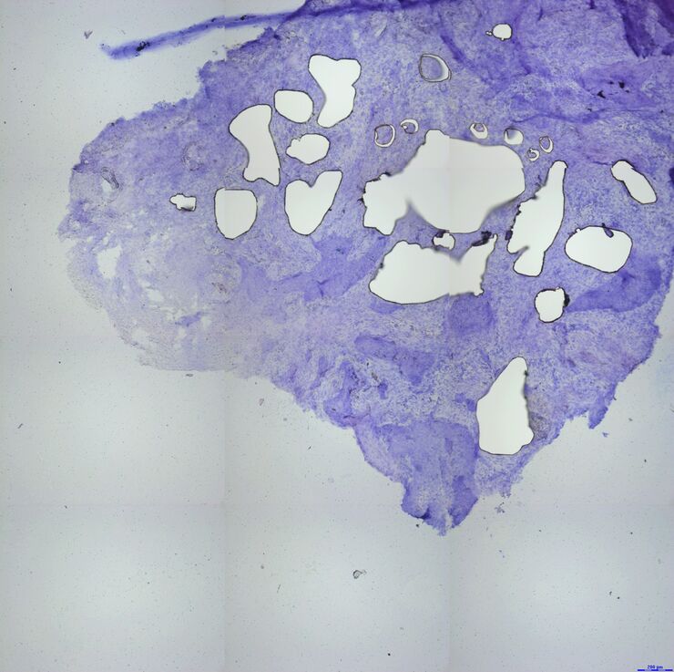 Exemplary Specimen Overviews of a customer sample with many tumor areas being dissected