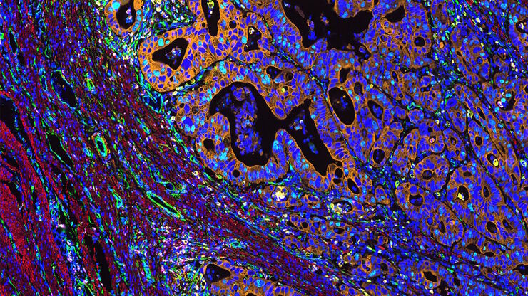 Multiplexed Cell DIVE imaging of Colon Adenocarcinoma (CAC) tissue. A panel of approximately 30 biomarkers targeted towards various leukocyte lineages, epithelial, stromal, and endothelial cell types was utilized to characterize the tumor immune microenvironment in human colon adenocarcinoma (CAC) tissue.