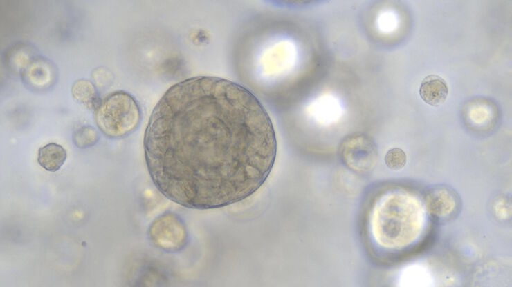 40x magnification of organoids cluster taken on Mateo TL.Cell type: esophageal squamous carcinoma; scale  bar 15µm. Courtesy of bioGenous, China. 
