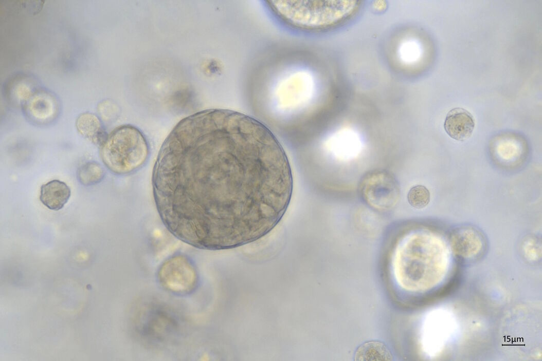 [Translate to chinese:] 40x magnification of organoids cluster taken on Mateo TL.Cell type: esophageal squamous carcinoma; scale  bar 15µm. Courtesy of bioGenous, China.  Esophageal_squamous_carcinoma_scale__bar_15_m.jpg