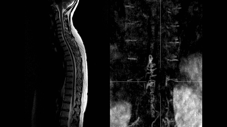 [Translate to chinese:] Spinal MRI of a patient with a spinal arterio-venous fistula. Image courtesy of Dr. Charlotte Flueh.