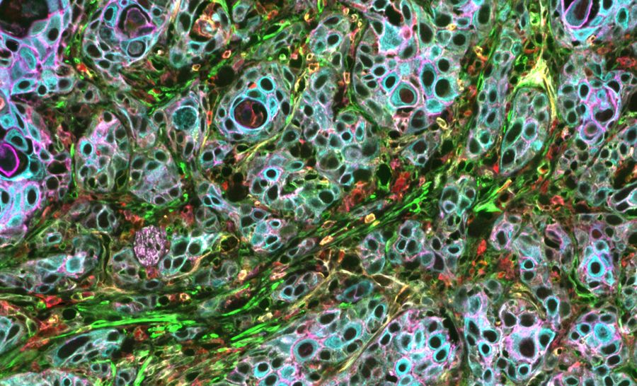 Figure 1. Pancreatic adenocarcinoma imaged with Cell DIVE, an iterative staining multiplex solution. 16 biomarkers shown: Collagen, NaK, pCadherin, PanCytokeratin, PKM2, SMA, Vimentin, AE1, Beta-caenin, Caspase9, CD3, CD4, CD8, CD20, CD31, and CD45.