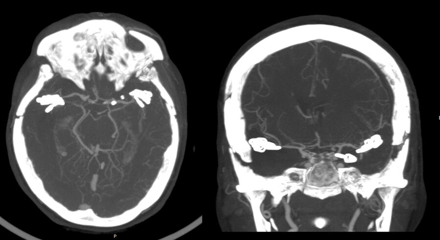 CT Angiogram showing clip positions