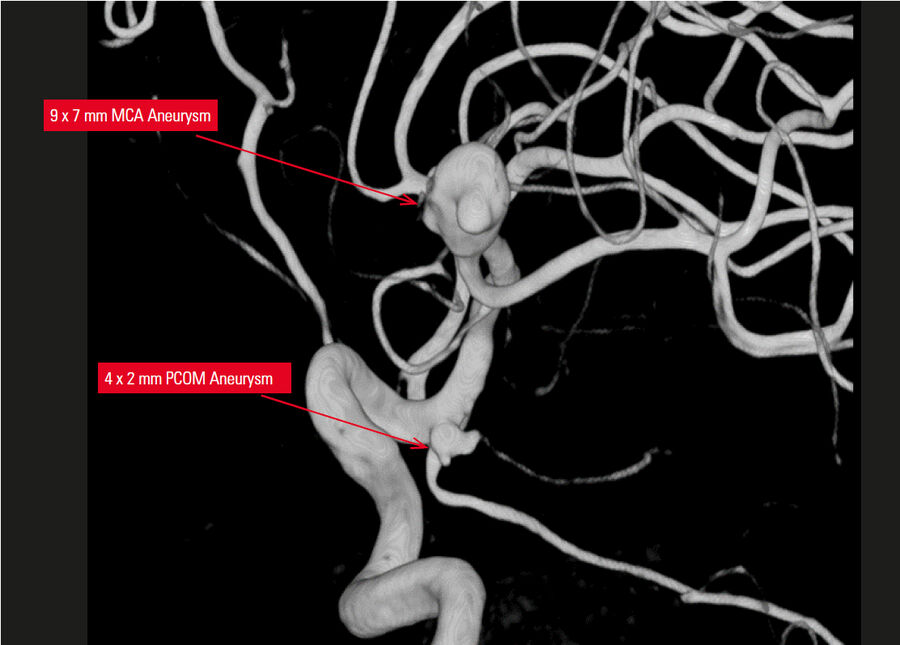 3D reconstruction showing both the MCA and PCOM aneurysms.