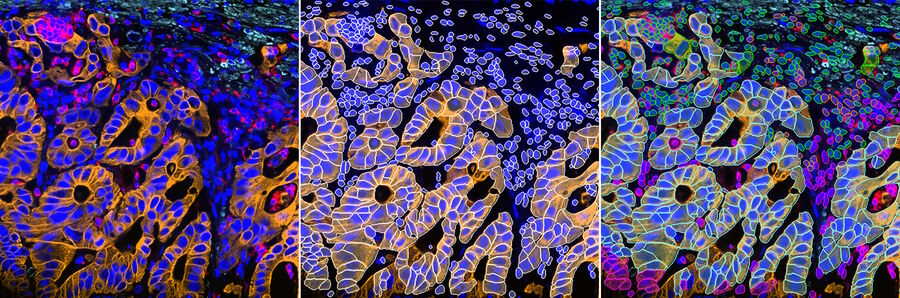 2D slice of colon cancer tissue stained with 30 markers and imaged using the Cell DIVE system. Analysis performed using Aivia 13’s new multiplex cell detection recipe and automatic clustering tool. Original image (left), detected cell membrane shown in white (middle), each phenotype denoted in a different color (right).