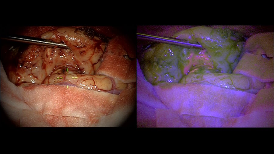 [Translate to chinese:] Operating on a brain tumor with 5-ALA fluorescence guidance. Image courtesy of Dr. Guirish Solanki.