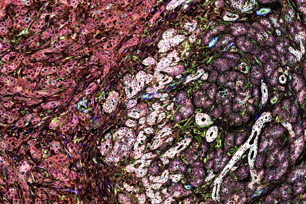 Pancreatic Ductal Adenocarcinoma with 11 Aerobic Glycolysis/Warburg Effect biomarkers shown – BCAT, Glut1, HK2, HTR2B, LDHA, NaKATPase, PCAD, PCK26, PKM2, SMA1, and Vimentin. Pancreatic_Ductal_Adenocarcinoma_11_Aerobic_Glycolysis_Markers_ROI3.jpg