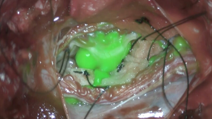 [Translate to chinese:] Solid tumor removal with GLOW800. Image courtesy of Dr. Christof Renner.