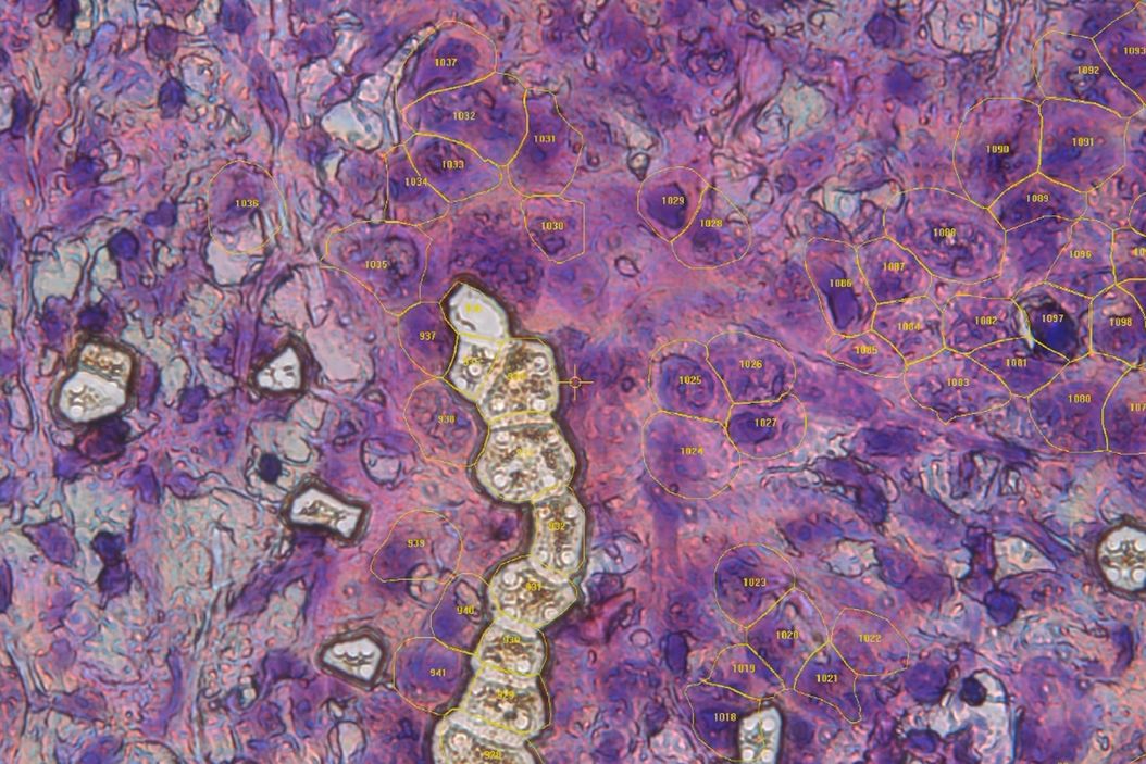 Single cells collected via laser microdissection as part of the Deep Visual Proteomics workflow. DVP_workflow_single_cells_collected_via_laser_microdissection.jpg
