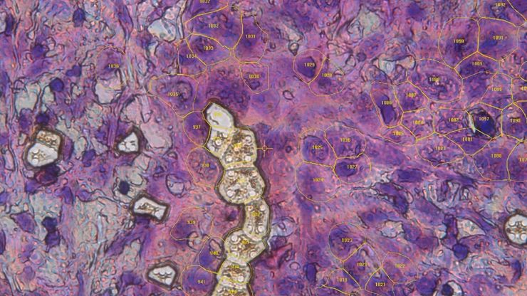 Single cells collected via laser microdissection as part of the Deep Visual Proteomics workflow. Single cells collected via laser microdissection as part of the Deep Visual Proteomics workflow.