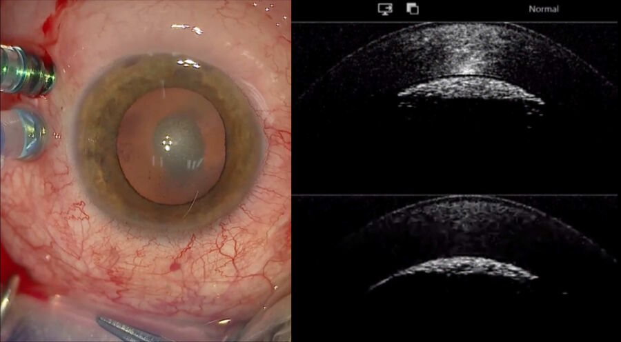 [Translate to chinese:] Silicone oil bubbles under the cornea.