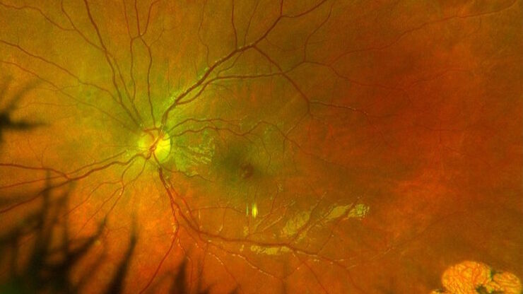 Fundus photo depicting epiretinal membrane with lamellar macular hole. Image courtesy of Robert A. Sisk, MD, FACS, Cincinnati Eye Institute. Fundus photo depicting epiretinal membrane with lamellar macular hole. Image courtesy of Robert A. Sisk, MD, FACS, Cincinnati Eye Institute.