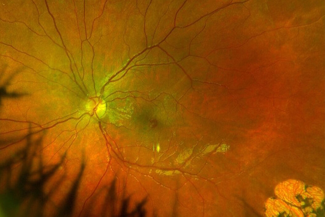 Fundus photo depicting epiretinal membrane with lamellar macular hole. Image courtesy of Robert A. Sisk, MD, FACS, Cincinnati Eye Institute.  Epiretinal-membrane-with-lamellar-macular-hole.jpg