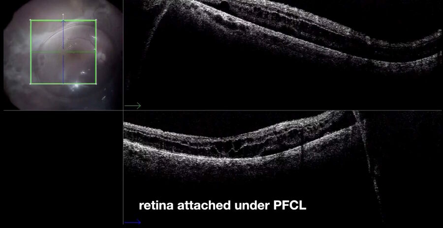 [Translate to chinese:] Intraoperative view of the same case as shown in Fig 11. The retina is attached under PFCL.