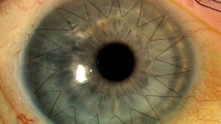 Corneal transplantation. Image courtesy of Mr. David Anderson.