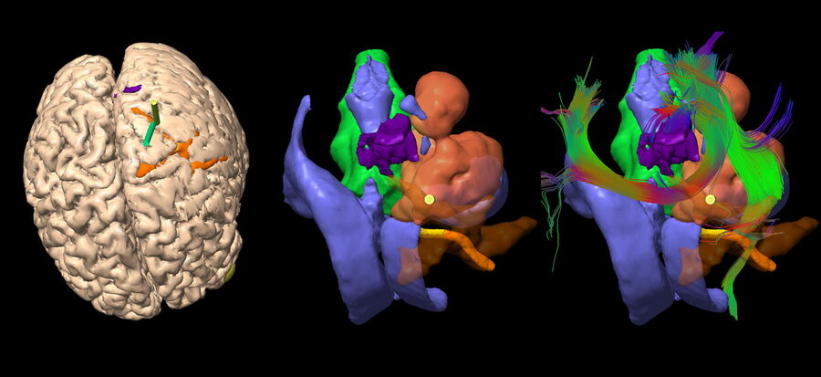 [Translate to chinese:] Patient positioning and trajectory design with Augmented Reality. Image courtesy of Prof. Philippe Bijlenga.