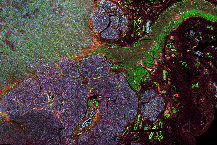 [Translate to chinese:] Pancreatic ductal adenocarcinoma tissue section imaged with Cell DIVE 