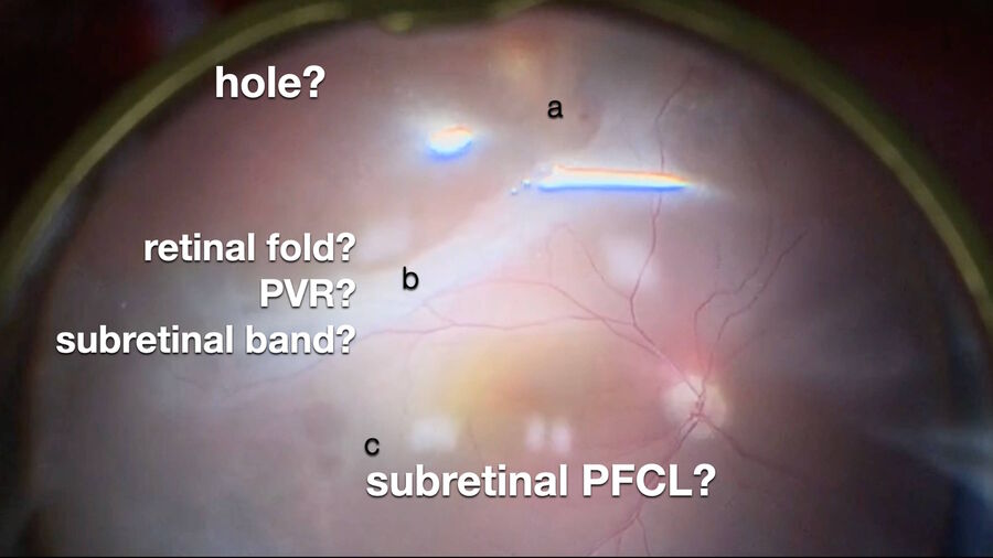 [Translate to chinese:] High magnification of the initial intraoperative view.