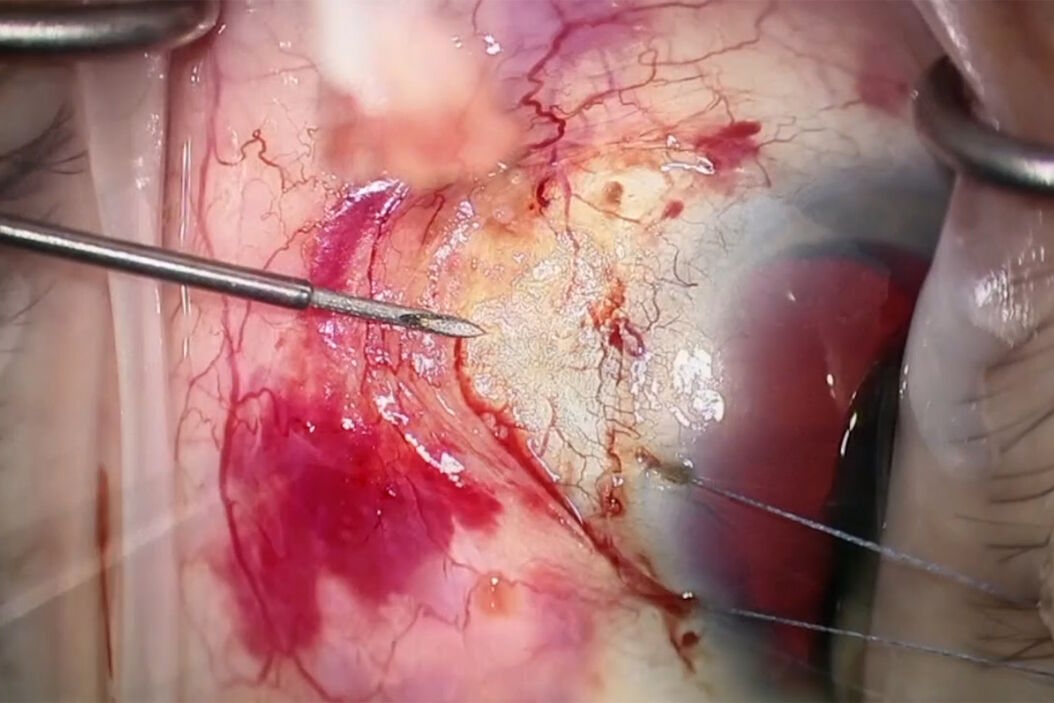 [Translate to chinese:] Dr. Sheybani places the new subconjunctival stent in the anterior chamber. Images courtesy of Arsham Sheybani, MD. Subconjunctival_stent_in_the_anterior_chamber.jpg