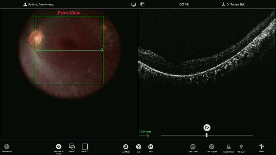 [Translate to chinese:] Macular scan performed to document the pre-injection anatomy. Images provided by Robert A. Sisk, MD, FACS .